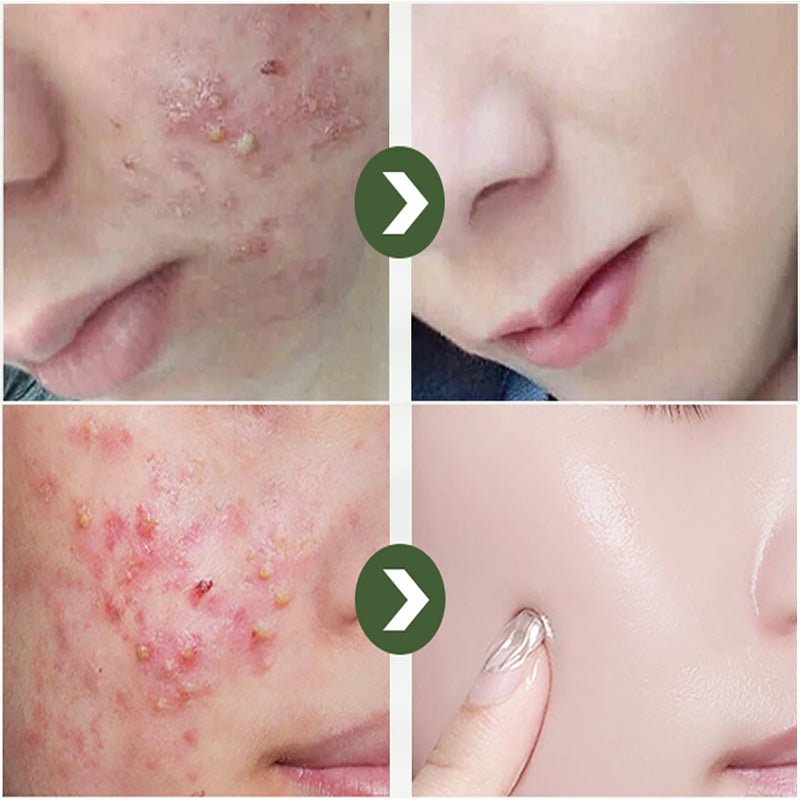 LANBENA Acne Removal Serum Salicylic Acid Anti-Acne Repair Fade Acne Spots Pimple Oil Control Cream Whitening Moisturizing Care - Starttech Online Market