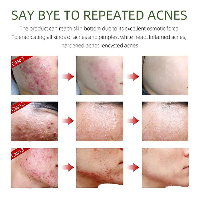 LANBENA Acne Removal Serum Salicylic Acid Anti-Acne Repair Fade Acne Spots Pimple Oil Control Cream Whitening Moisturizing Care - Starttech Online Market